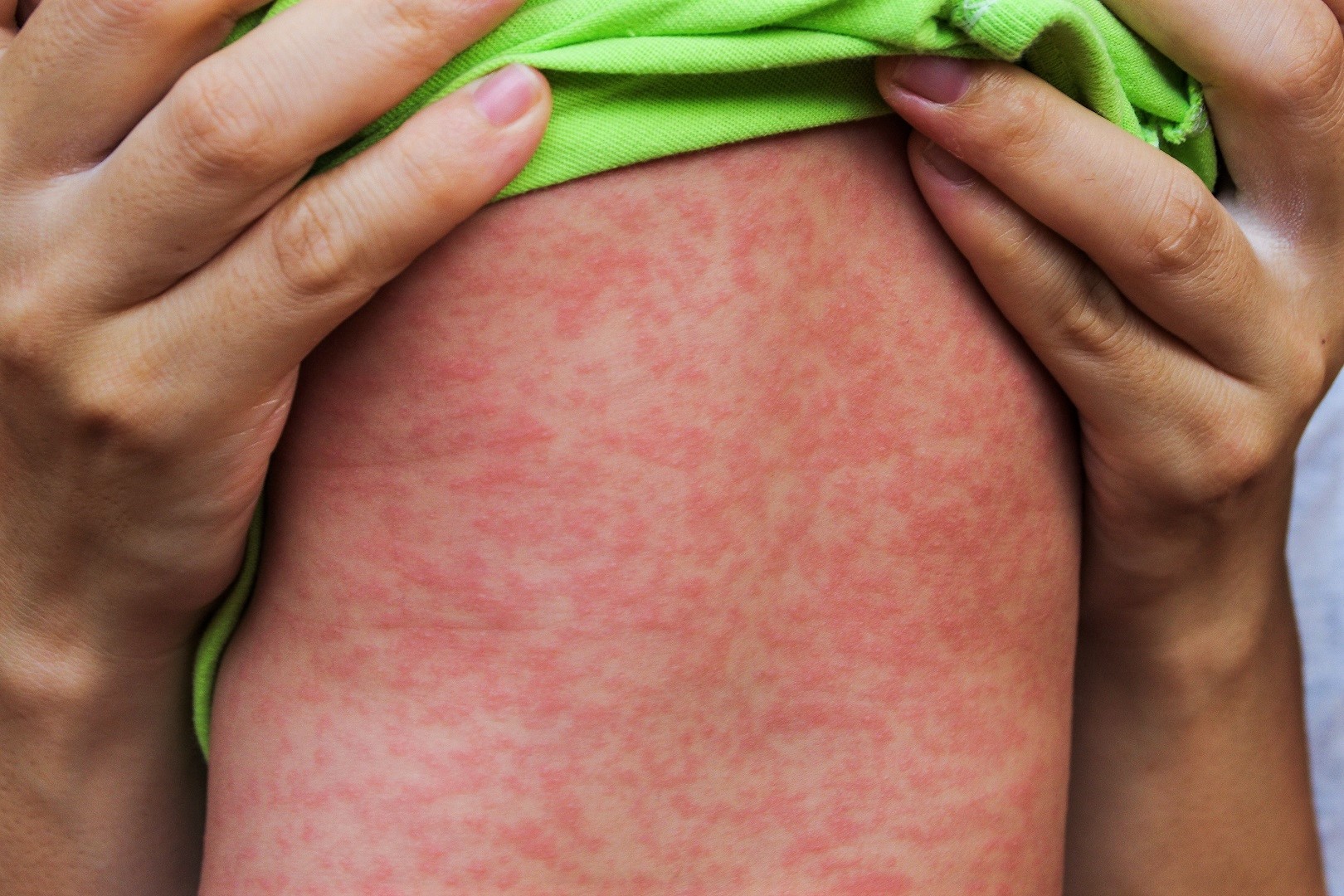 Measles Rash On Body