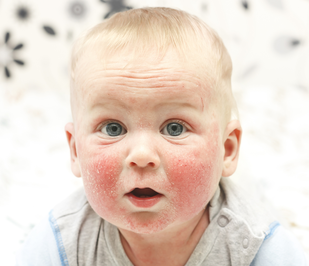 Baby with eczema